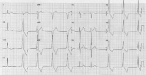 Accelerated Idioventricular Arrhythmia