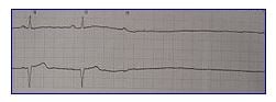 Asystole