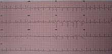 Atrial Fibrillation