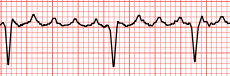 Atrial Flutter