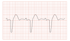 Bundle Branch Block