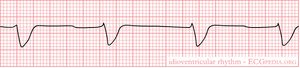 Idioventricular Rhythm