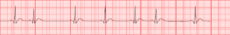 Premature Atrial Contractions