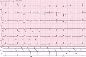 Second Degree Atrioventricular Block, Type I