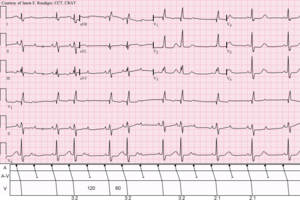 Second-Degree Atrioventricular Block, Type II