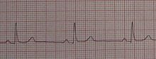 Sinus Bradycardia