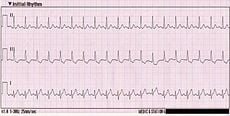 Sinus Tachycardia