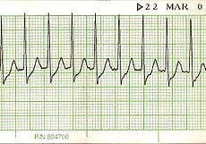 Supraventricular Tachycardia