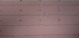 Third Degree Heart Block