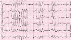 Torsades de Pointes