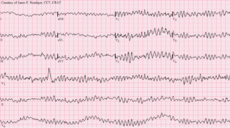 Ventricular Fibrillation