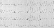 Ventricular Tachycardia